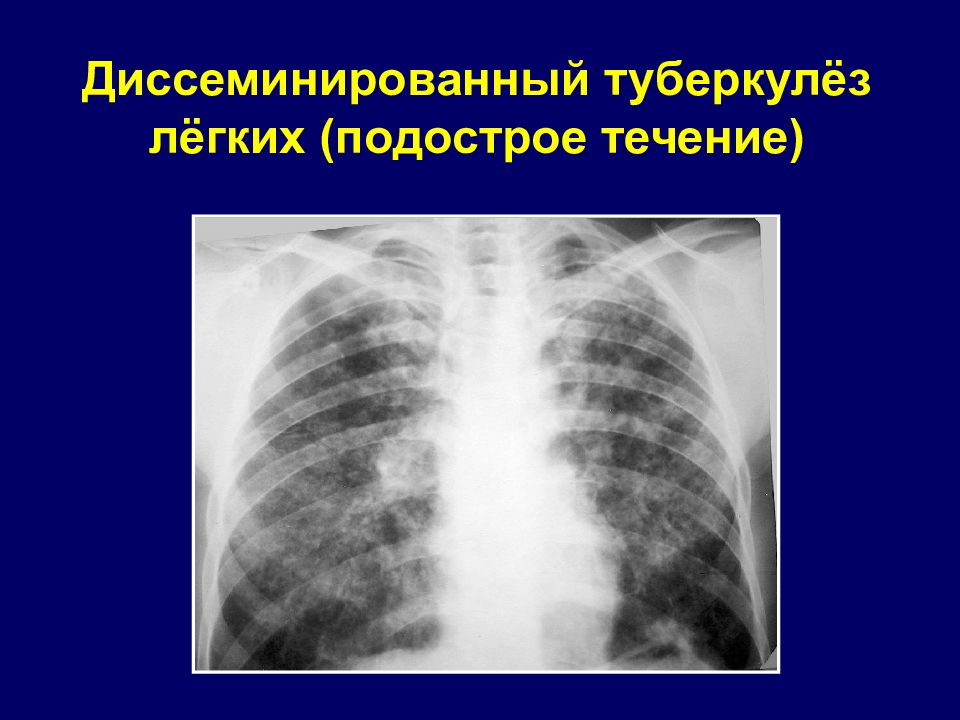 Каким путем туберкулез легких. Милиарный туберкулез рентген. Подострый диссеминированный туберкулез рентген. Милиарный туберкулез рентгенограмма. Первичный диссеминированный туберкулез рентген.