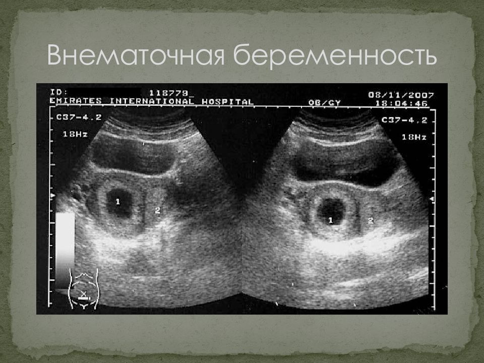 Тест после внематочной. Внематочная беременность. Внематочная беременность на УЗИ. Гетеротопической беременности. Трубная беременность УЗИ.