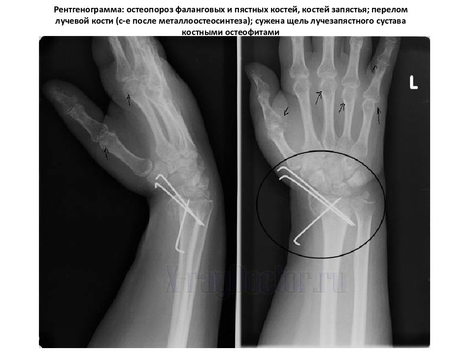 Спицы в пальце при переломе. Рентген лучезапястный сустав перелом лучевой кости. Металлоостеосинтез пястной кости. Костная мозоль на рентгене лучевой кости. Перелом лучевой кости в лучезапястном суставе.