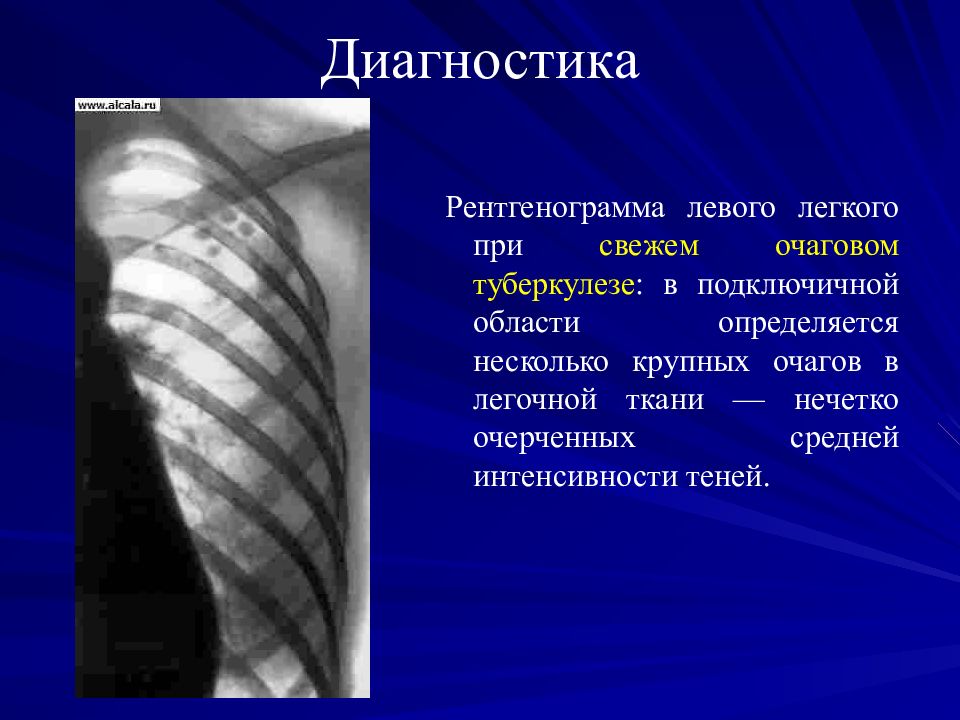 Очаговые изменения в легких презентация