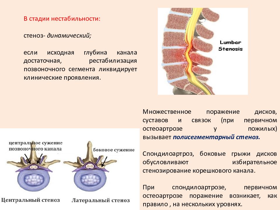 Поясничный позвоночный стеноз