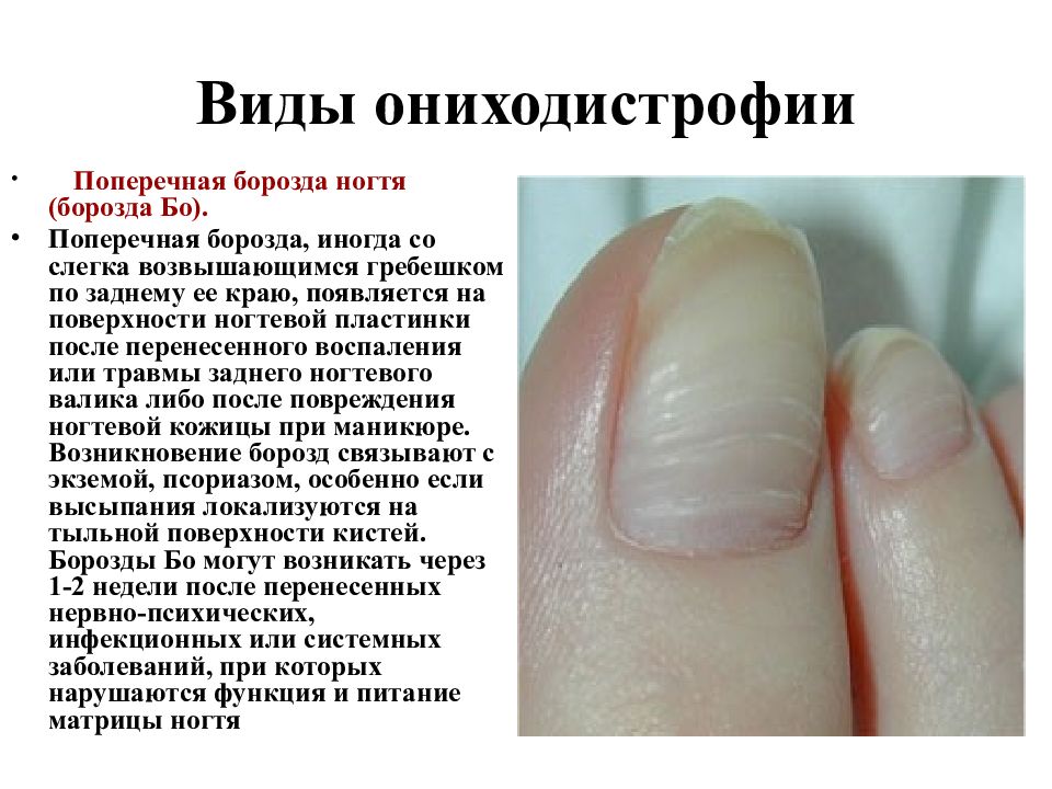 Полоса на ногте причины и лечение. Поперечные борозды на ногтях рук. Продольные борозды на ногтях.