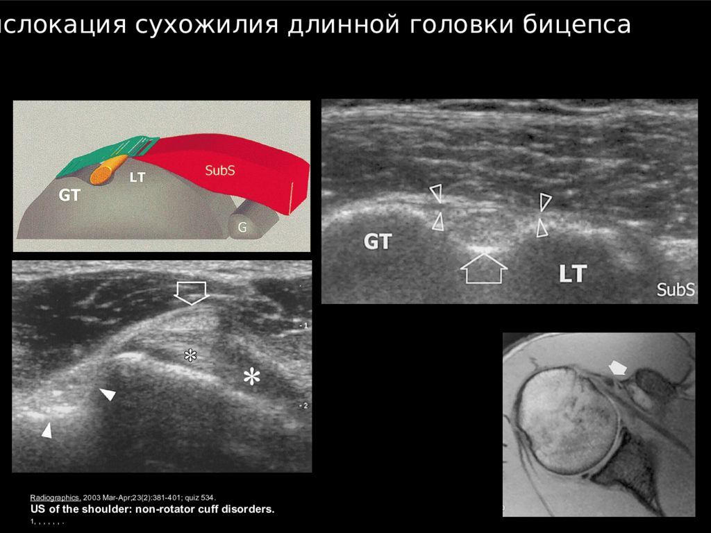 Узи плечевого. УЗИ плечевого сустава норма. Отрыв головки бицепса на УЗИ. Разрыв сухожилия бицепса УЗИ. УЗИ отрыв сухожилия двуглавой мышцы.
