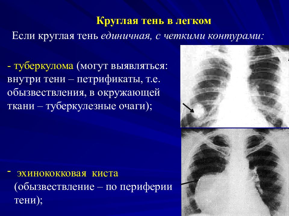 Обызвествление. Обезвествление туберкулезного очага. Обызвествление туберкулезного очага. Обызвествление лимфоузлов в легких на рентгене.