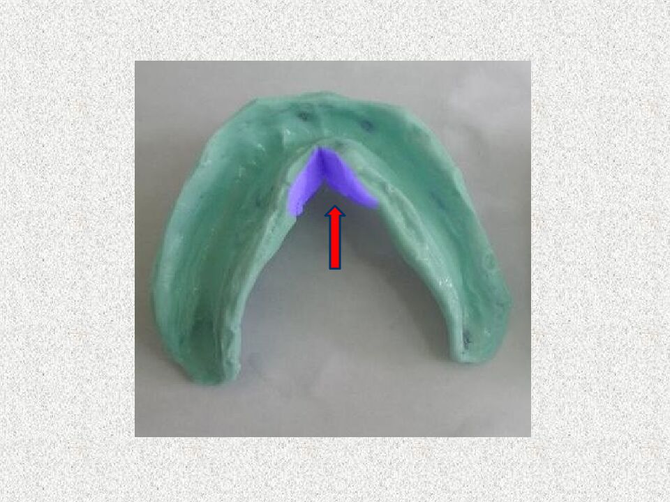 Funksional otisklar uchun individual qoshiqchalar