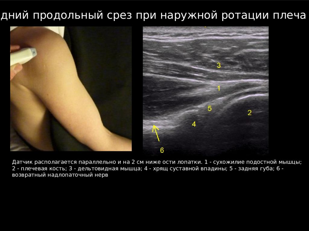 Обследование плечевого сустава. Ультразвуковое исследование плечевого сустава. УЗИ плечевого сустава презентация. УЗИ плечевого сустава протокол исследования. Сухожилие подостной мышцы на УЗИ.