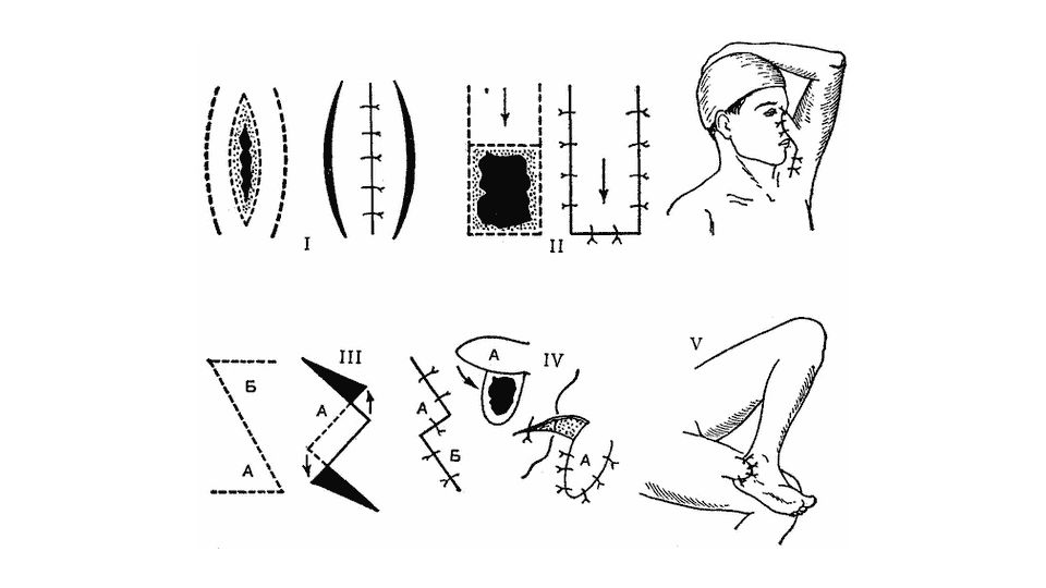 Свободный лоскут. Лимберг пластика местными тканями. Пластика методом лоскут Лимберга. Кожная пластика по Лимбергу схема. Кожная пластика местными тканями по Лимбергу.