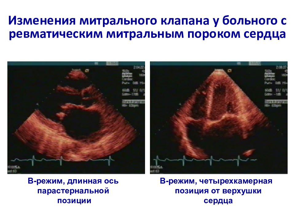 Эхокг митральный клапан. Митральный клапан ЭХОКГ. Митральная недостаточность Эхо. Пролапс митрального клапана на ЭХОКГ. Порок митрального клапана на ЭХОКГ.