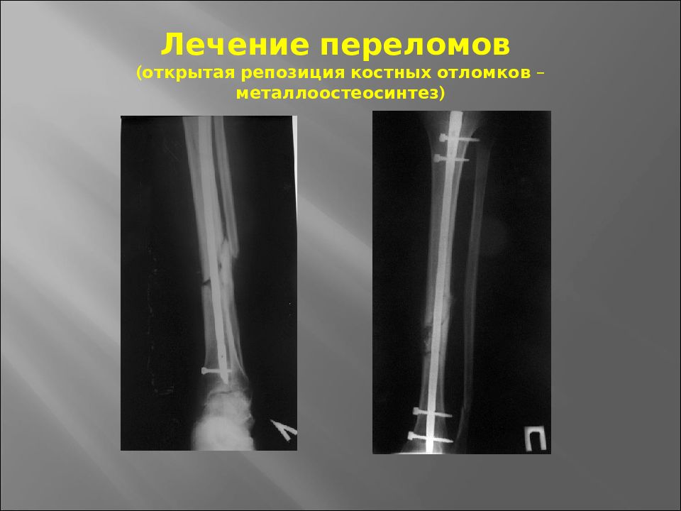 Перелом предплечья травматология презентация