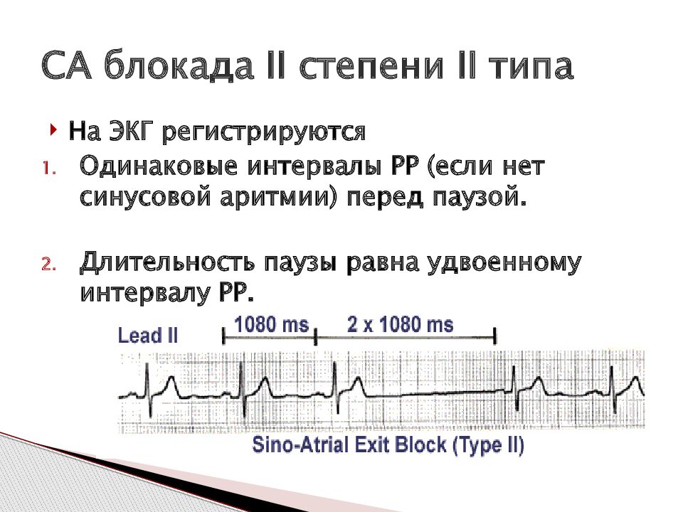 Что значат блокады на экг. Синоатриальная блокада 2 степени Мобитц 1. Синоатриальная блокада 2 степени 2 типа. Синоатриальная блокада 2 степени 1 типа. Синоаурикулярная блокада 2 степени на ЭКГ.
