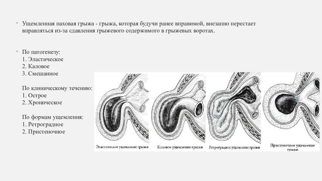 Эластическое ущемление грыжи. Ущемленная паховая грыжа. Ущемленная грыжа карта вызова.