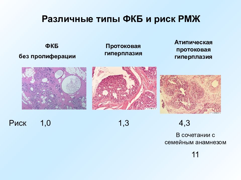 Клетки протокового эпителия. Атипическая протоковая гиперплазия. Атипическая гиперплазия молочной железы. Атипическая протоковая гиперплазия молочной железы. Фиброзно-кистозная болезнь гистология.