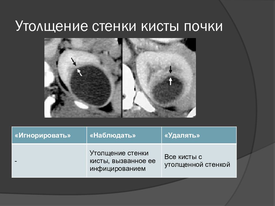 Утолщение стенок. Утолщение стенок почек. Стенки почки. Утолщение стенки кисты на почке. Инфицирование кисты почки.