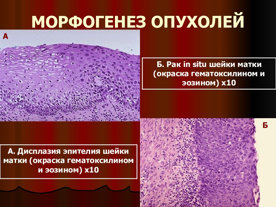 Карцинома in situ наружной шейки матки