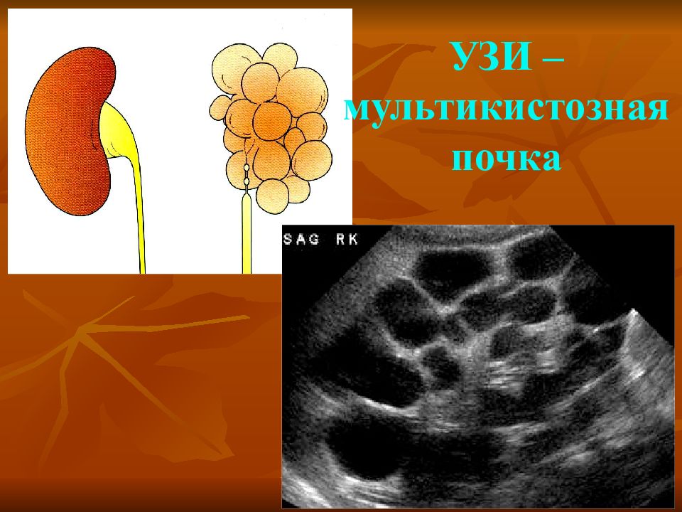 Поликистоз инфильтративного типа мелкокистозного типа дает эхографическую картину