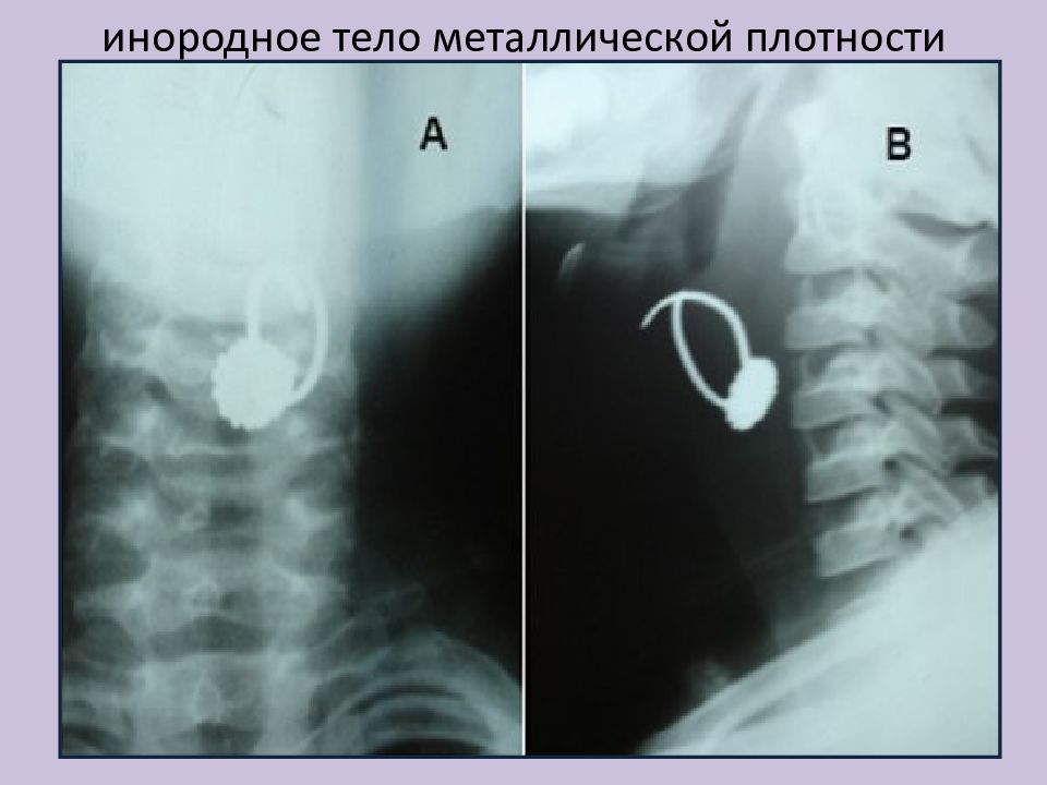 Попал предмет. Инородное тело пищевода рентген. Инородное тело гортани рентген. Инородное тело в дыхательных путях рентген. Инородное тело пищевода рентген снимки.