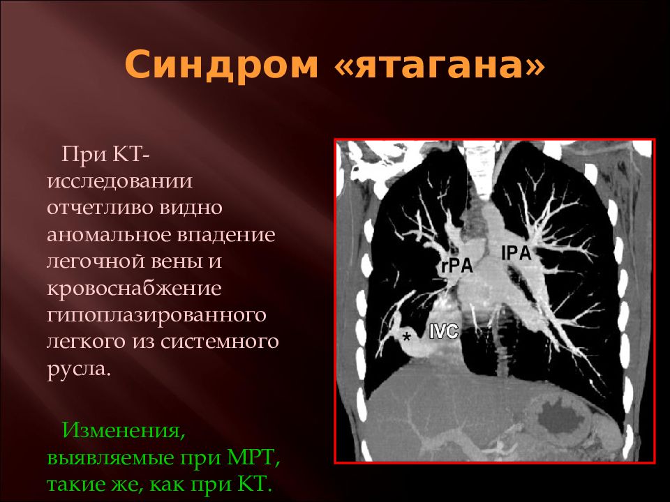 Врожденные заболевания легких. Аномалие впадение легочных вен.