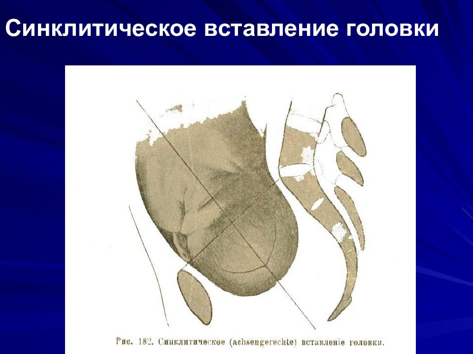 Вставление головки виды