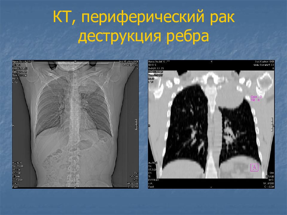 Деструкция ребра. Деструкция ребра рентген. Метастатическое поражение ребер.