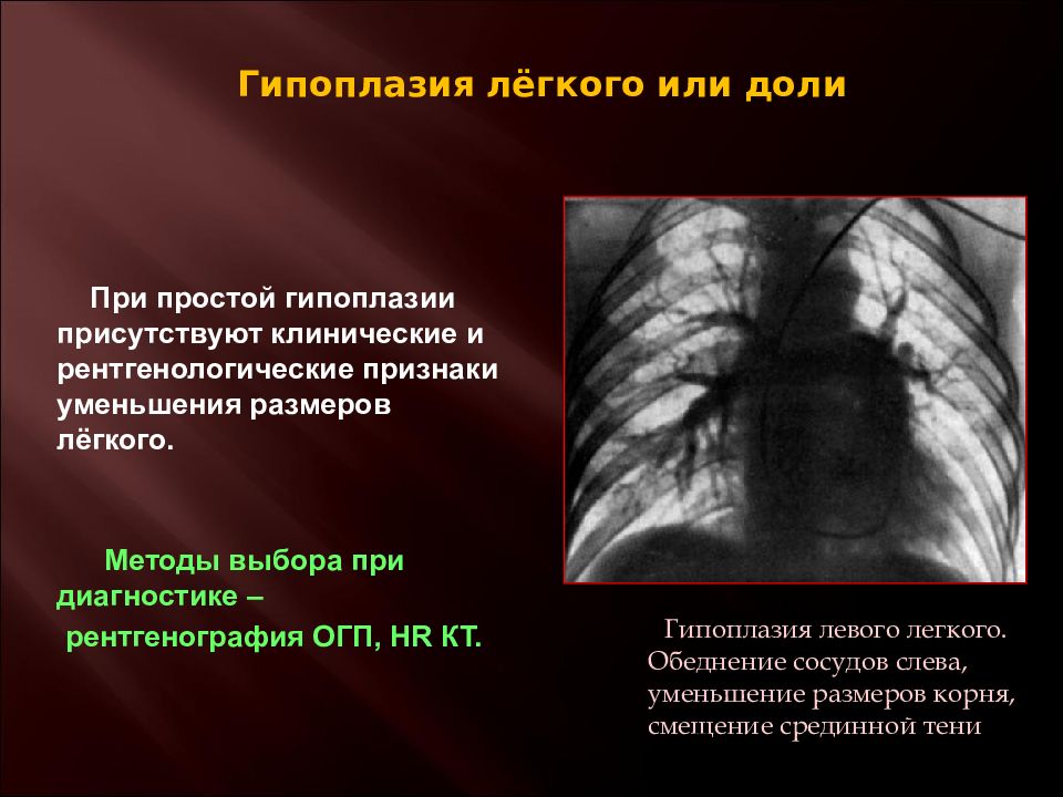 Пороки развития легких презентация