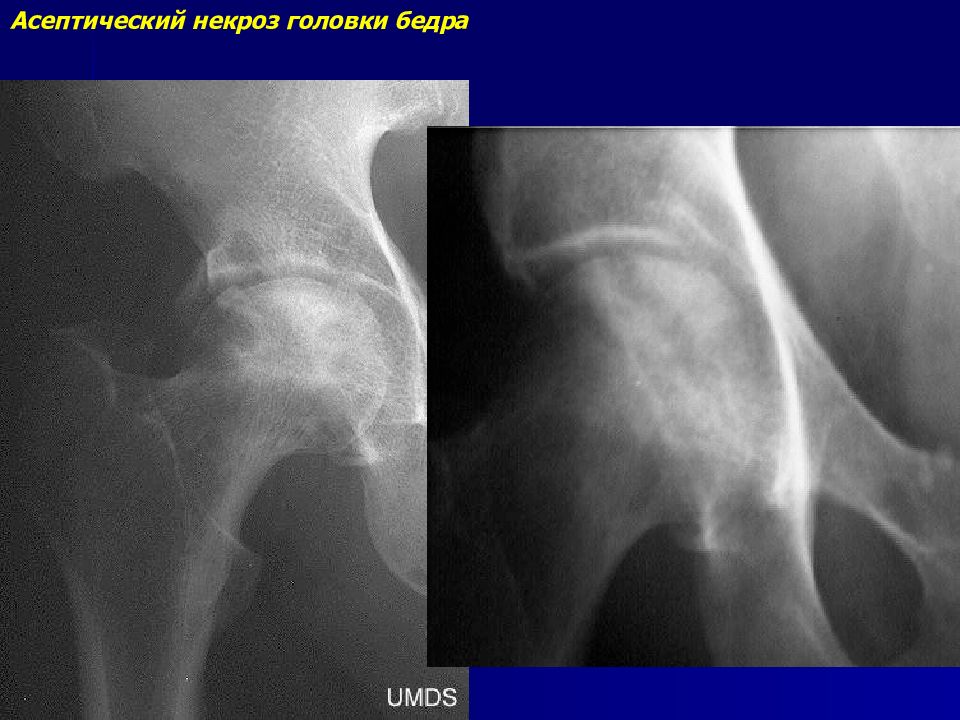 Асептический некроз головки бедренной кости сустава. Асептический некроз головки бедренной кости кт. Асептический некроз головки бедра. Асептический некроз головки плечевой кости. Асептический некроз головки бедра у собак.