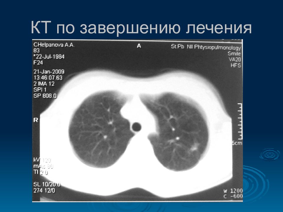 Лечишься окончание. Клетки Халлера кт. Остаточная полость после пульмонэктомии кт. Кардиоторакальный индекс на кт. Селезеночный индекс на кт.