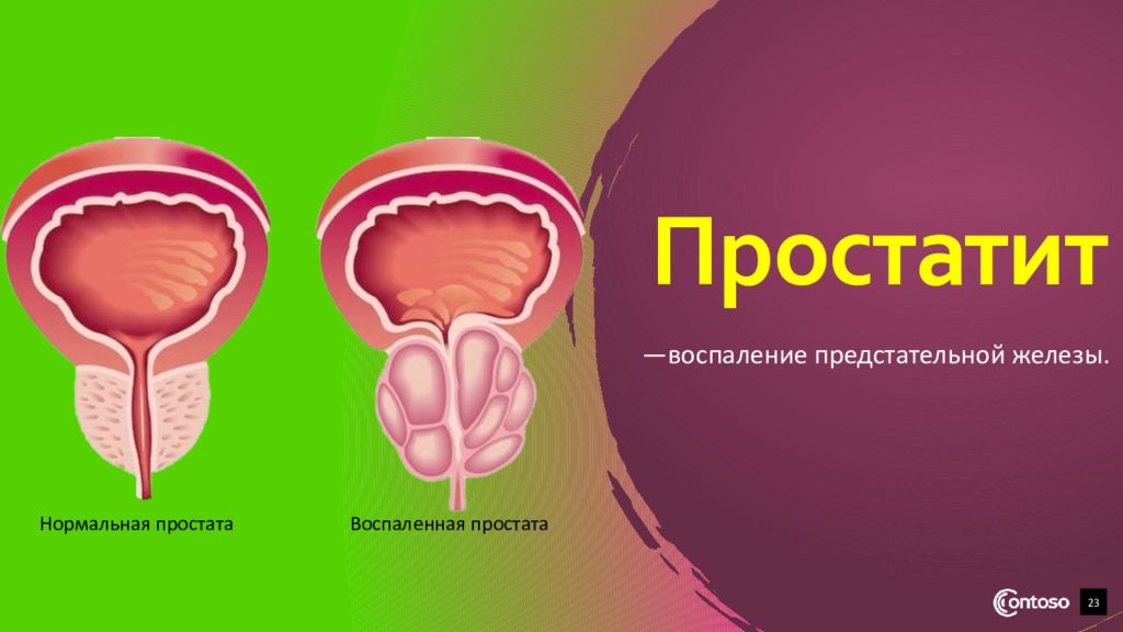 Хронический простатит презентация