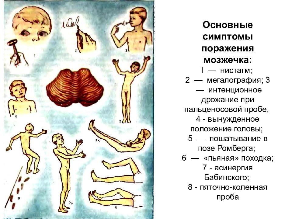 Интенционное дрожание