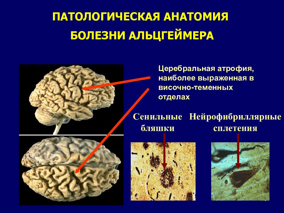 Презентация когнитивные нарушения