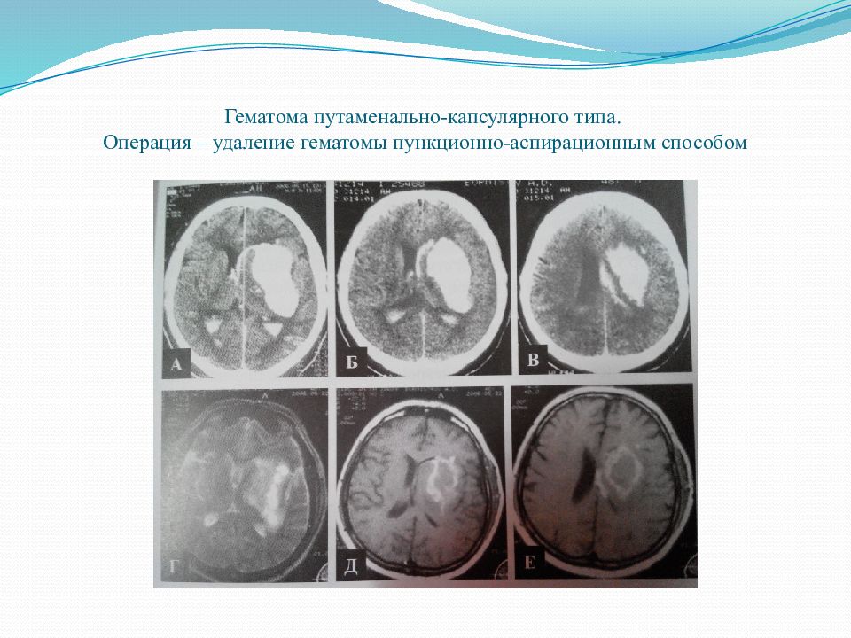 Гематома мозга операция