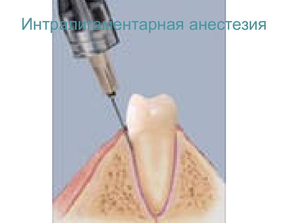 Что такое анестезия в стоматологии. Интралигаментарная анестезия и инфильтрационная. Интралигаментарная анестезия sta. Интралигаментарная пародонтальная спонгиозная анестезия. Интерлигаменталный анестезия.