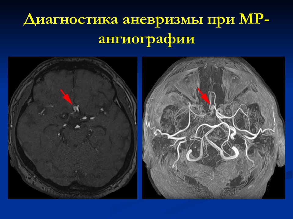 Аневризм головного мозга. Разрыв аневризмы головного мозга кт.