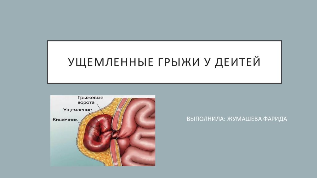 Ущемленные грыжи презентация хирургия.