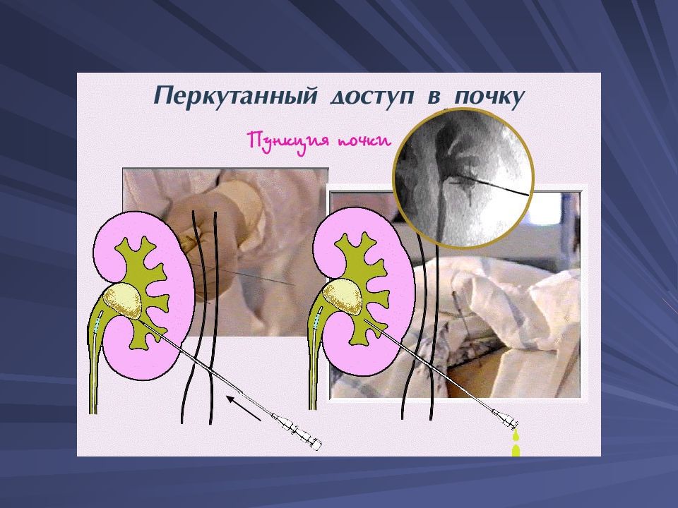 Мочекаменная болезнь картинки для презентации