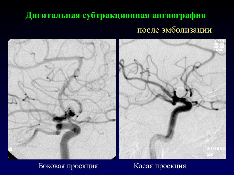 цифровая субтракционная ангиография dsa. цифровая субтракционная ангиография dsa. катетерная цифровая субтракционная ангиография. дигитальная субтракционная ангиография. цифровая субтракционная ангиография.