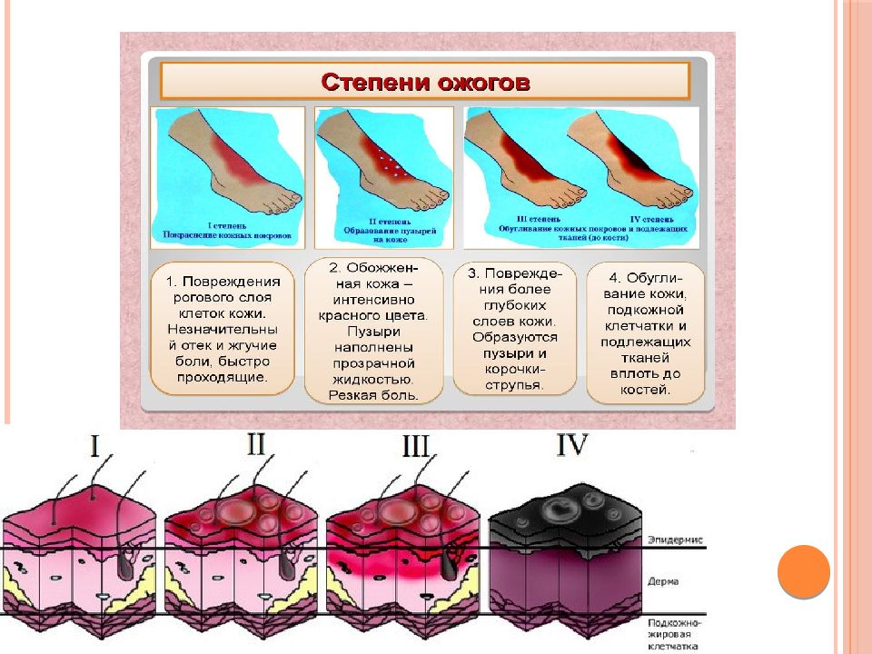 Охарактеризовать степени ожогов. Схема ожогов. Степени химических ожогов.