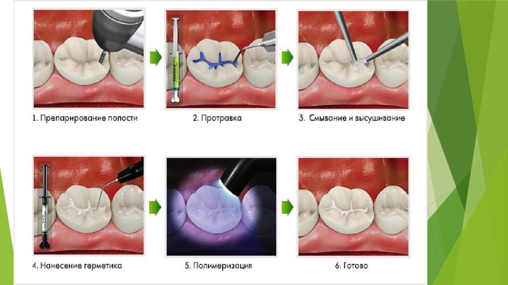 Диагностика кариеса. Высушивание кариозной полости. Реминерализационной терапии кариеса. Протравка кариозной полости.
