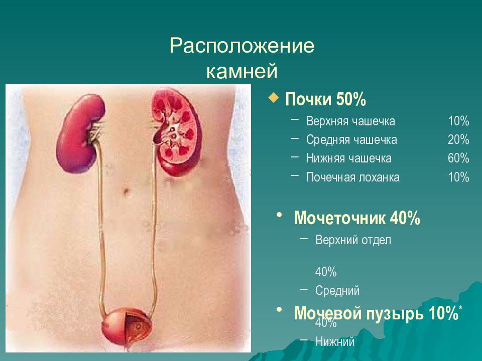 Презентация по мочекаменной болезни