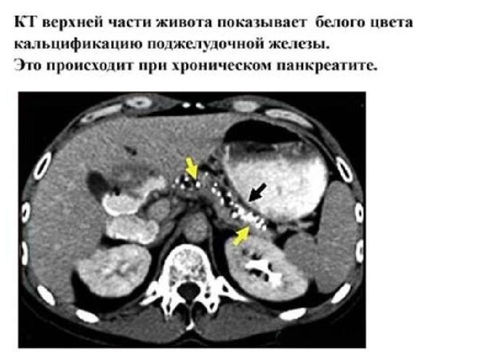 Кт признаки поджелудочной железы. Хронический панкреатит кт. Хронический калькулезный панкреатит кт. Калькулезный панкреатит кт. Кт при хроническом панкреатите.