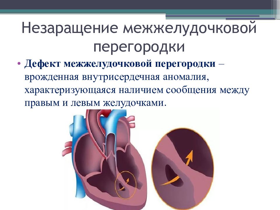 Межжелудочковая перегородка. Незаращение межжелудочковой перегородки. Порок межжелудочковой перегородки. Незарощениемежелудочковойперегородки. Дефект межжелудочковой перегородки (ДМЖП).