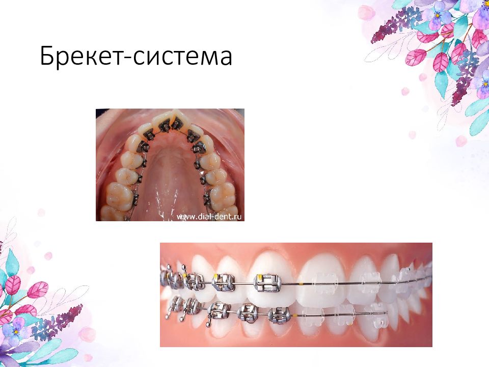 Классификация ортодонтических аппаратов презентация