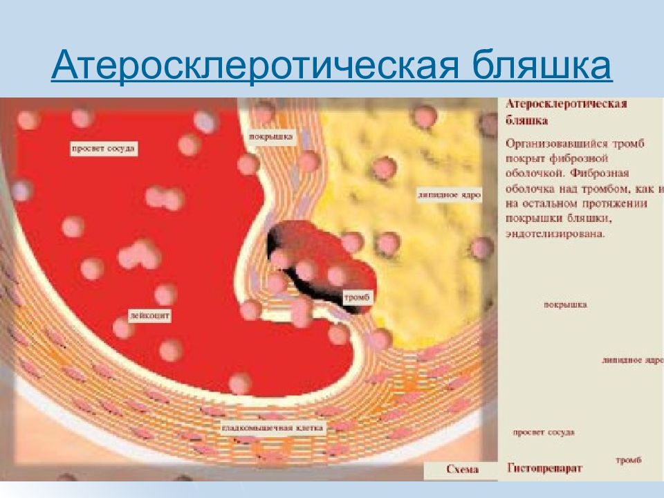 Стабильная атеросклеротическая бляшка. Атеросклеротическая бляшка. Воспаление и атеросклероз. Строение атеросклеротической бляшки. Структура атеросклеротической бляшки.