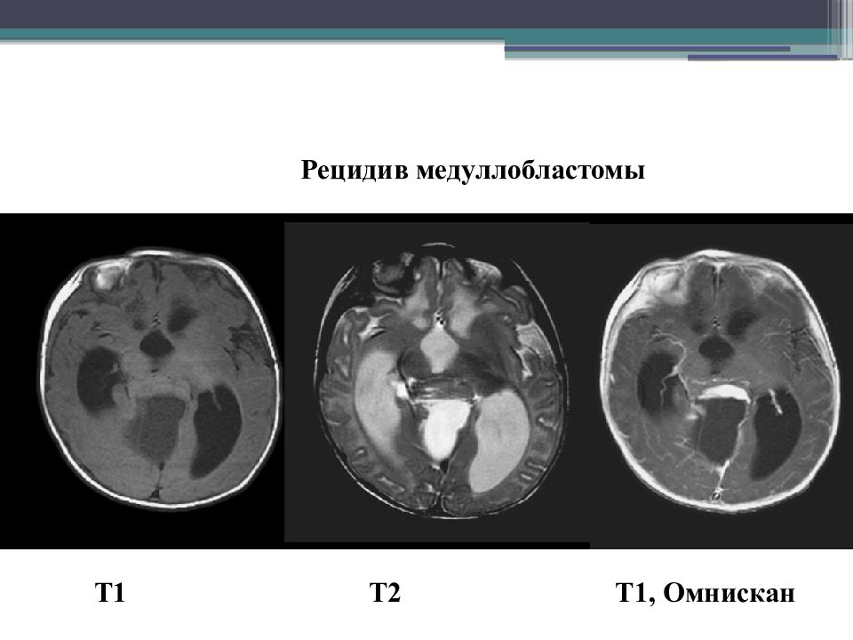 Динамическая мрт. Т1 и т2 взвешенные изображения. Т1 взвешенные изображения в мрт. Рецидив медуллобластомы.