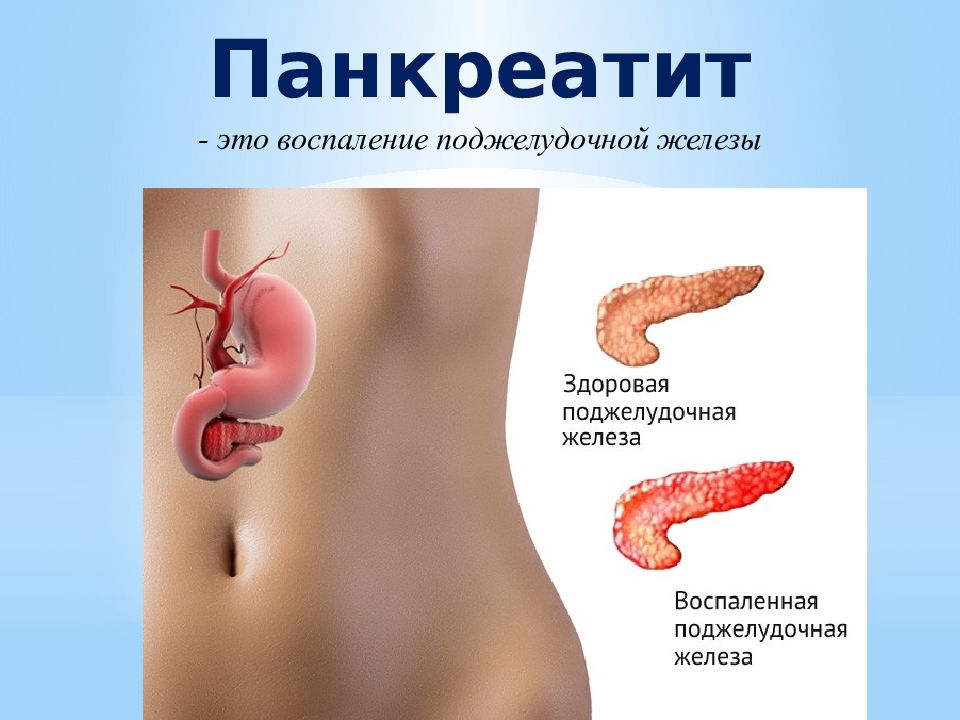 Панкреатит - это воспаление поджелудочной железы