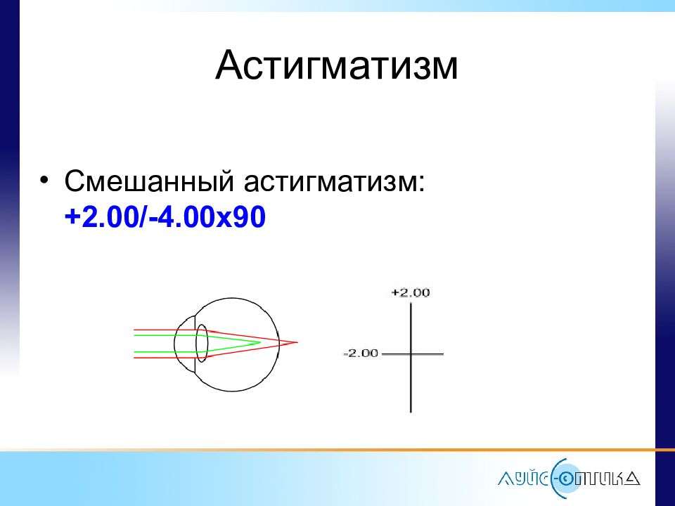 Смешанный астигматизм. Сложный гиперметропический астигматизм прямого типа. Сложный смешанный астигматизм. Смешанный миопический астигматизм. Смешанный астигматизм прямого типа.