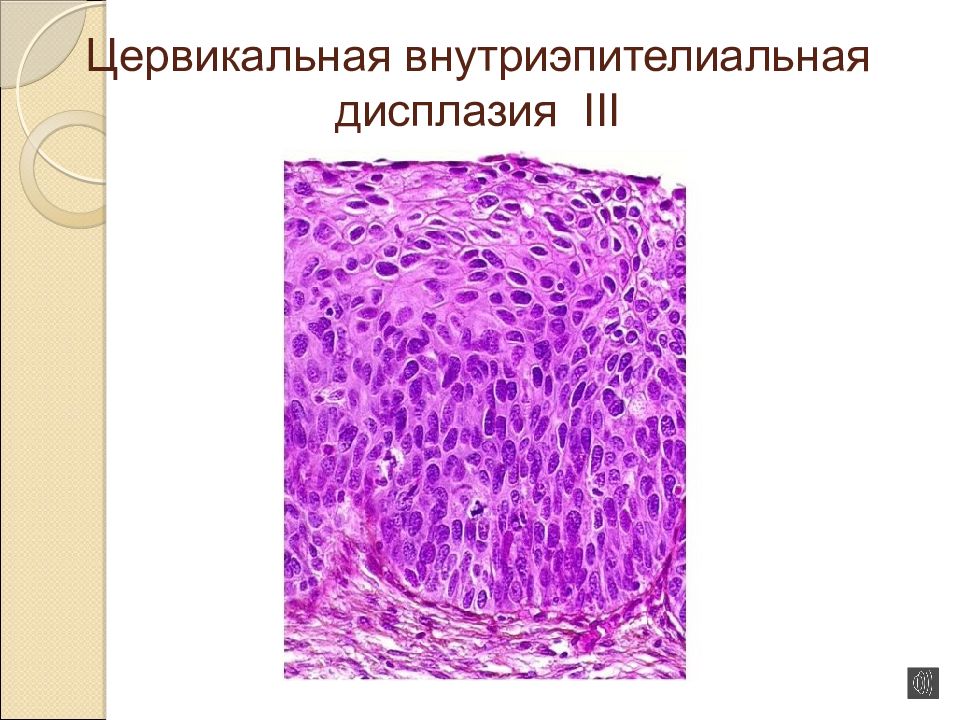Отсутствие внутриэпителиального поражения. Внутриэпителиальная неоплазия. Внутриэпителиальная инвазия бактерий. Внутриэпителиальное поражение плоского эпителия низкой степени. Внутриэпителиальная неоплазия фото.