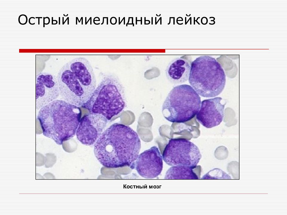 Острый миелобластный лейкоз у детей презентация