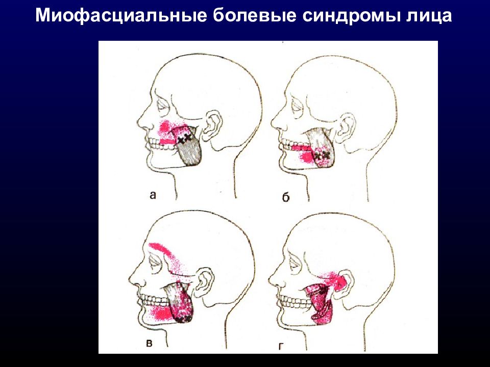 Миофасциальный болевой синдром. Миофасциальный болевой синдром неврология. Дисфункциональный болевой синдром лица. Миофасциальный болевой синдром височно нижнечелюстного сустава. Миофасциальный болевой Дисфункциональный синдром лица.