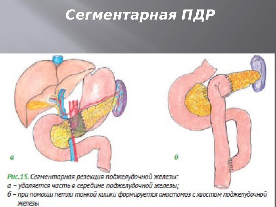 Пдр операция. ПДР поджелудочная железа. Операция ПДР на поджелудочной железы.