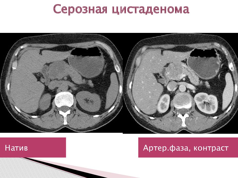 Муцинозная цистаденома поджелудочной железы. Цистаденома поджелудочной железы кт. Муцинозная опухоль поджелудочной железы на кт. Цистаденокарцинома поджелудочной железы кт. Серозная цистаденома поджелудочной железы кт.